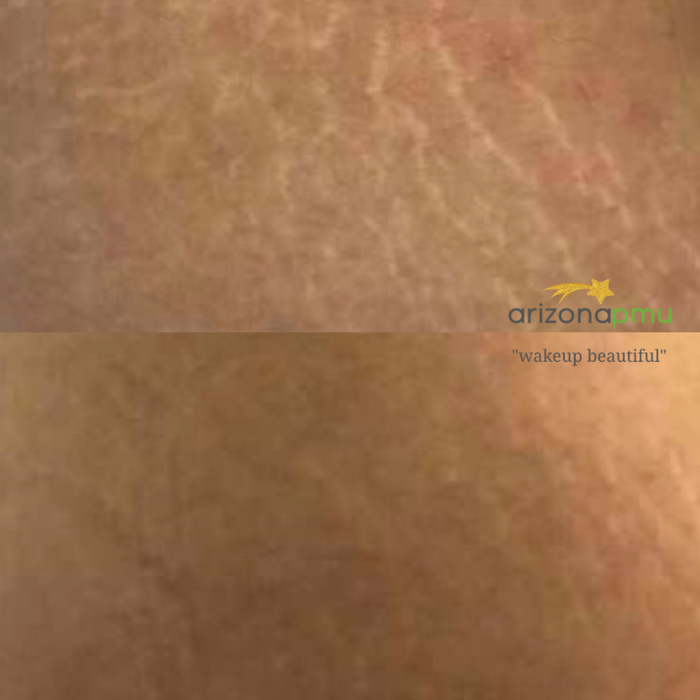 Stretch Mark Camouflage - AZ_permanent_makeup