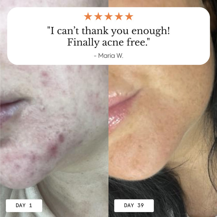 Frøya Organics Instant Rosacea, Acne & Redness Stopper glass jar close-up showing product label and size