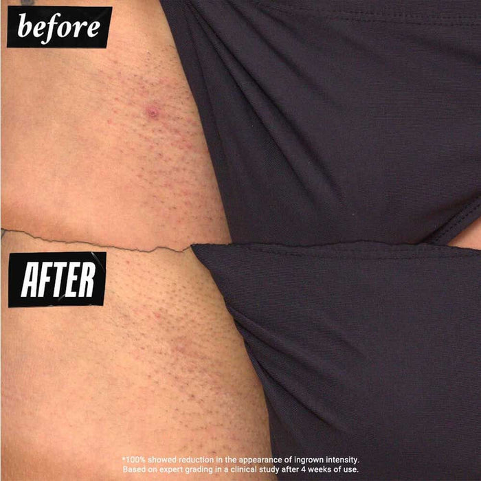 Kiehl's Ingrown Hair And Tone-Correcting Intimate Drops