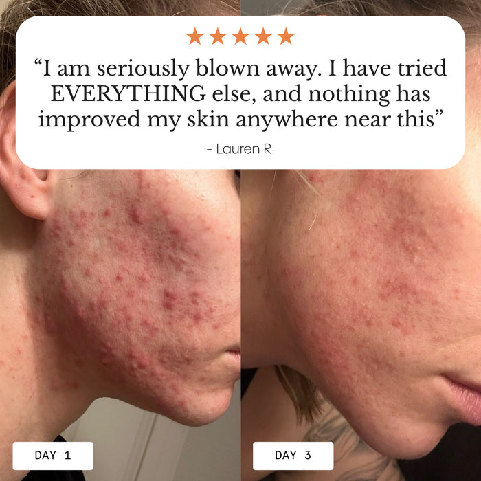 Frøya Organics Complete Acne System for Women glass jar close-up showing product label and size