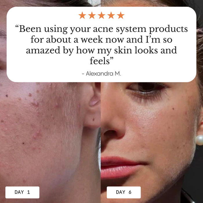 How to use Frøya Organics Complete Acne System for Women application guide
