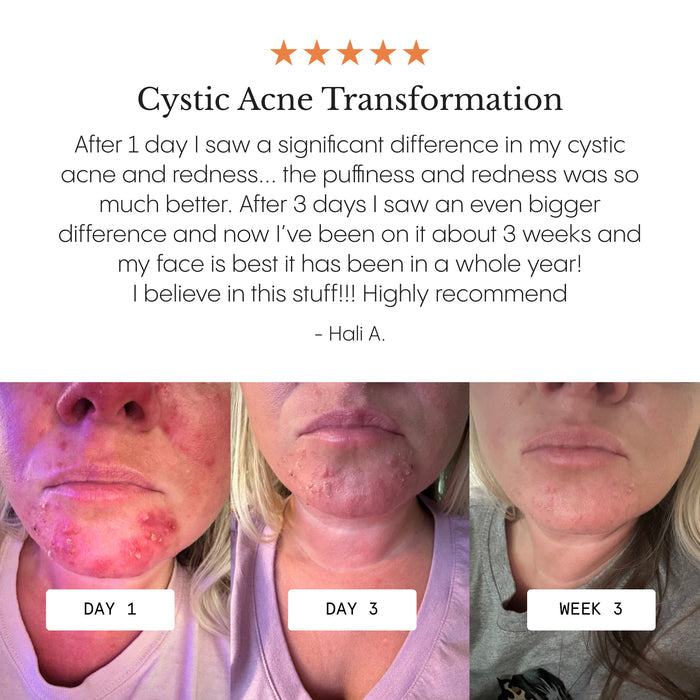Frøya Organics Complete Acne System for Women open jar revealing concentrated 4-step acne system texture
