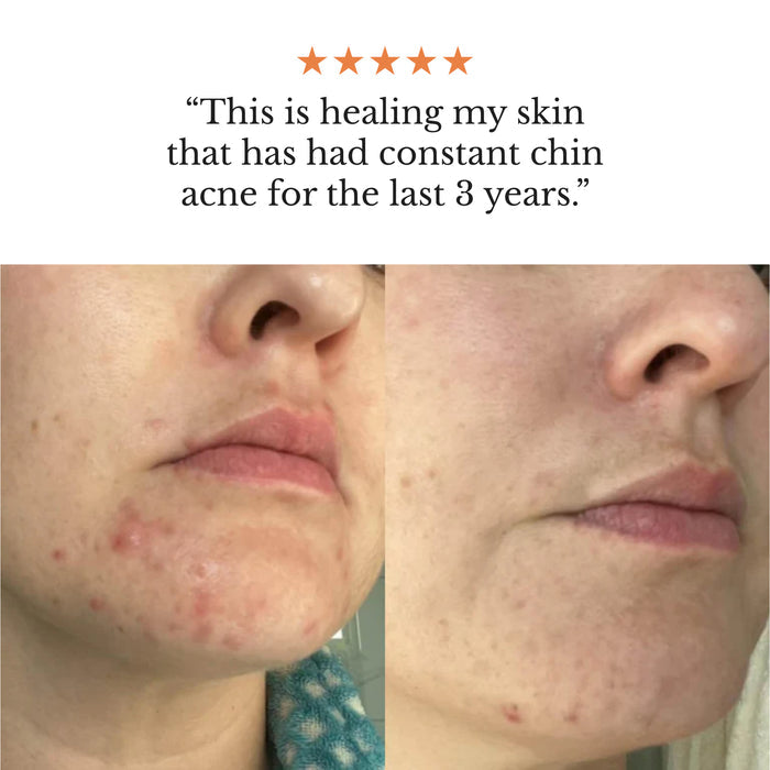 Frøya Organics Complete Acne System for Women key active ingredients from Arctic botanical sources